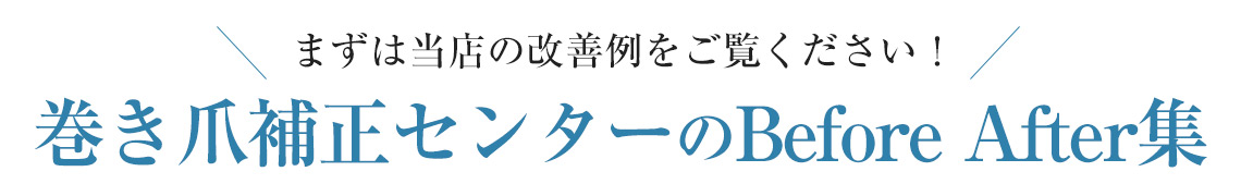 巻き爪ビフォーアフター